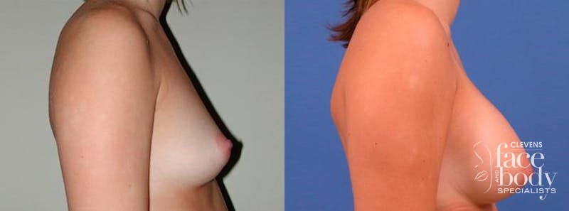 Hidden Breast Aug Before & After Gallery - Patient 125414 - Image 2