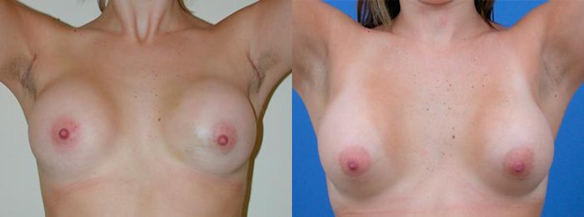 Breast Augmentation Before & After Gallery - Patient 417491 - Image 3