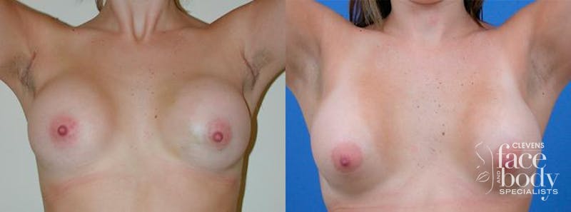 Hidden Breast Aug Before & After Gallery - Patient 125414 - Image 3