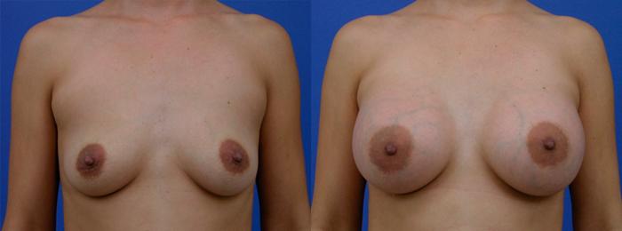Hidden Breast Aug Before & After Gallery - Patient 229495 - Image 1