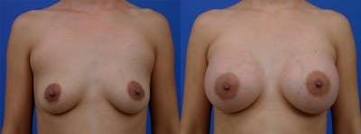 Breast Augmentation Before & After Gallery - Patient 240813 - Image 1