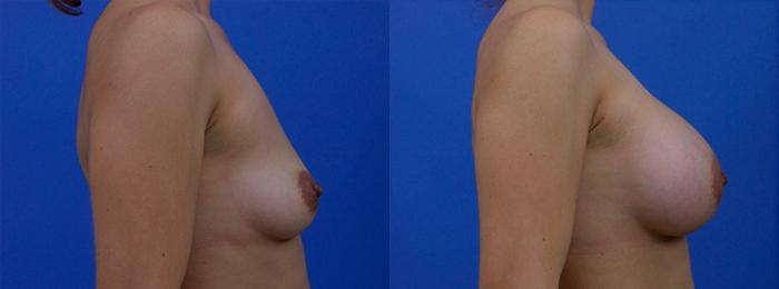 Hidden Breast Aug Before & After Gallery - Patient 229495 - Image 2