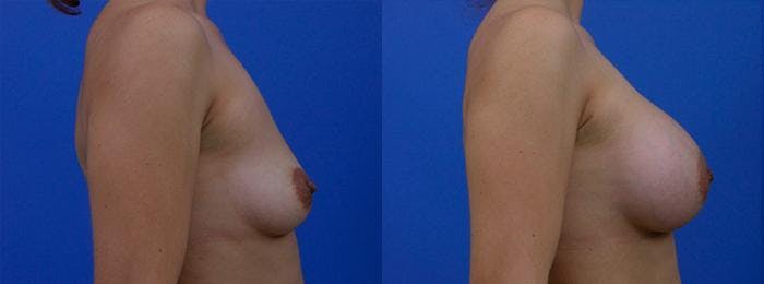 Breast Augmentation Before & After Gallery - Patient 122405465 - Image 2