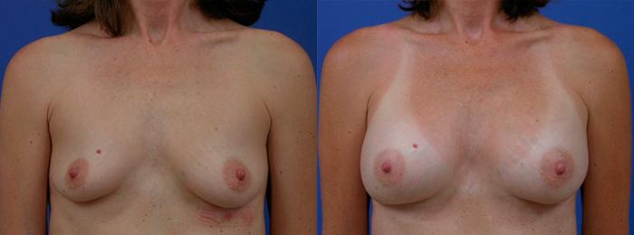 Hidden Breast Aug Before & After Gallery - Patient 158666 - Image 1