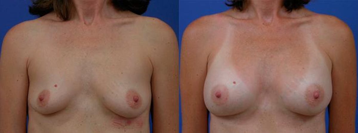 Breast Augmentation Before & After Gallery - Patient 164392 - Image 1