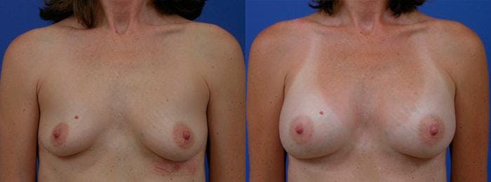 Breast Augmentation Before & After Gallery - Patient 122405466 - Image 1