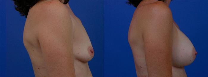 Hidden Breast Aug Before & After Gallery - Patient 158666 - Image 2
