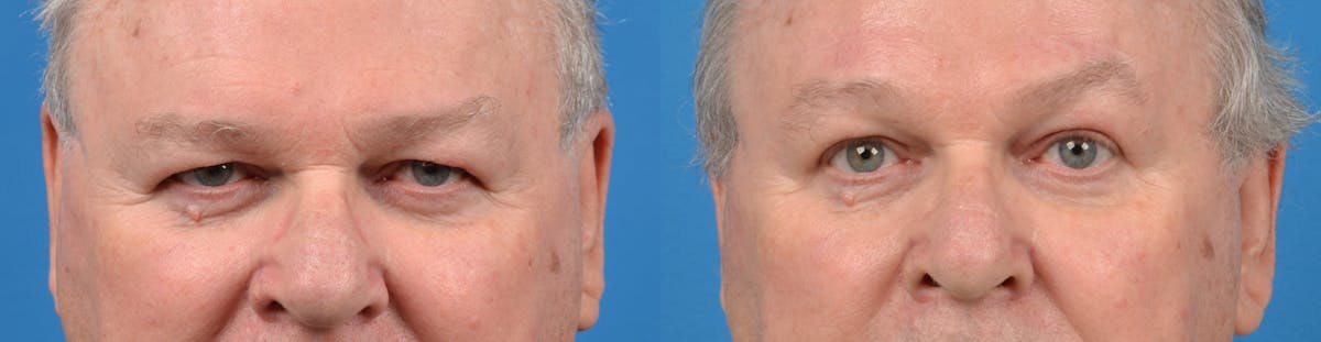 Brow Lift Before & After Gallery - Patient 122405468 - Image 1