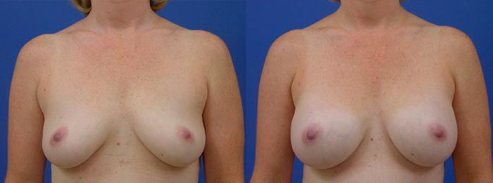 Hidden Breast Aug Before & After Gallery - Patient 760120 - Image 1