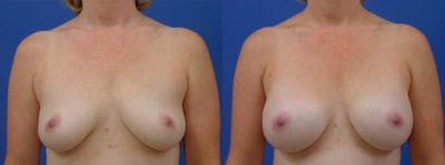 Breast Augmentation Before & After Gallery - Patient 122405467 - Image 1