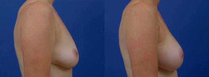 Hidden Breast Aug Before & After Gallery - Patient 760120 - Image 2