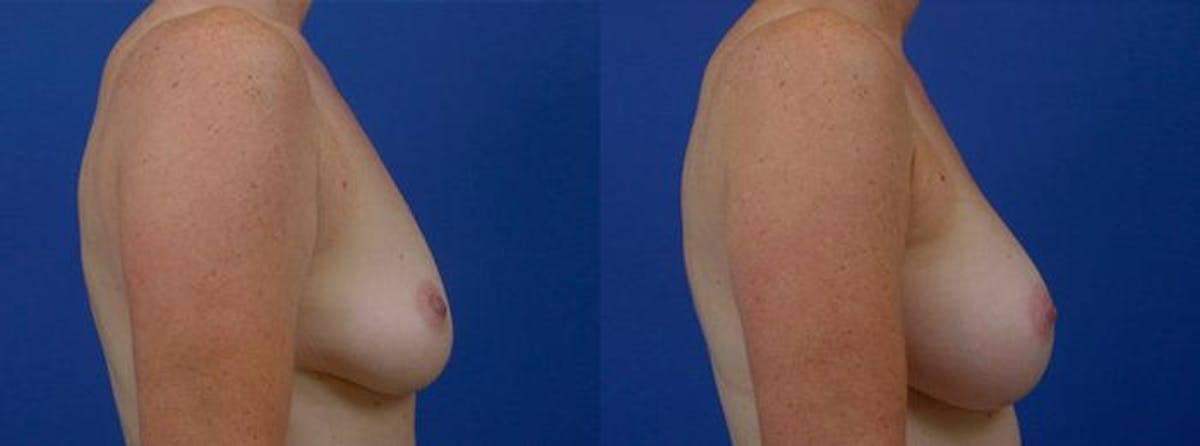 Breast Augmentation Before & After Gallery - Patient 329807 - Image 2