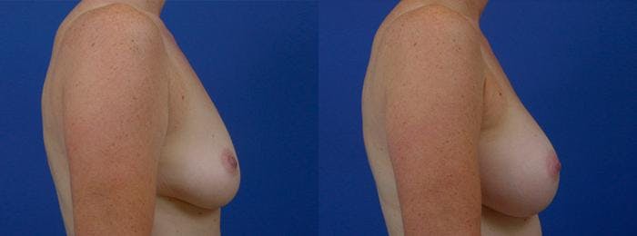 Breast Augmentation Before & After Gallery - Patient 122405467 - Image 2