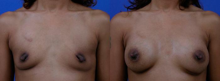 Hidden Breast Aug Before & After Gallery - Patient 239240 - Image 1