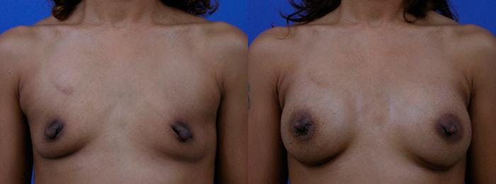 Breast Augmentation Before & After Gallery - Patient 122405469 - Image 1