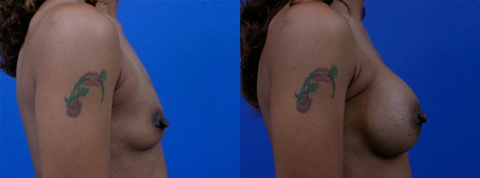Hidden Breast Aug Before & After Gallery - Patient 239240 - Image 2