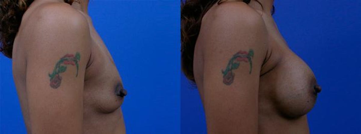 Breast Augmentation Before & After Gallery - Patient 365629 - Image 2
