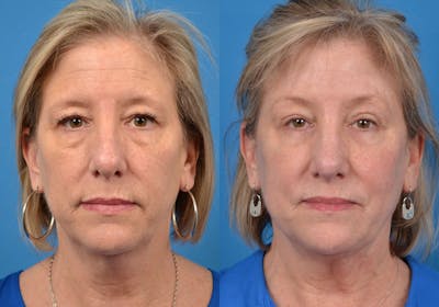 Brow Lift Before & After Gallery - Patient 122405471 - Image 1