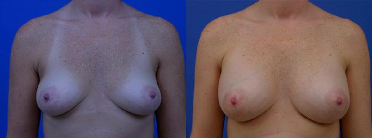 Breast Augmentation Before & After Gallery - Patient 350448 - Image 1