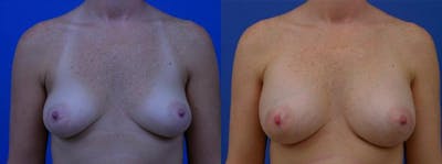 Breast Augmentation Before & After Gallery - Patient 122405470 - Image 1