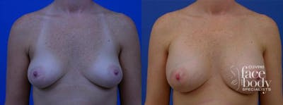 Hidden Breast Aug Before & After Gallery - Patient 176705 - Image 1