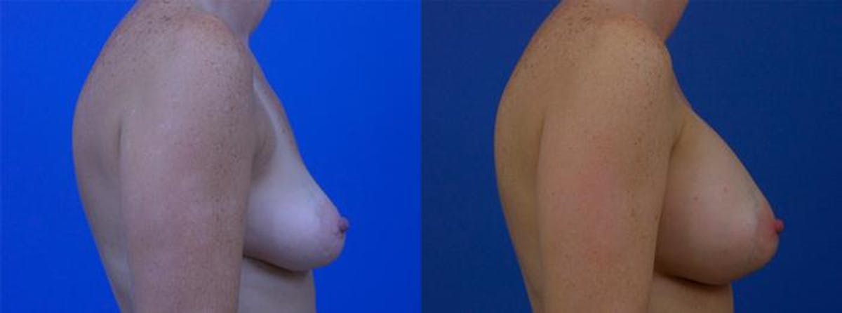 Breast Augmentation Before & After Gallery - Patient 350448 - Image 2