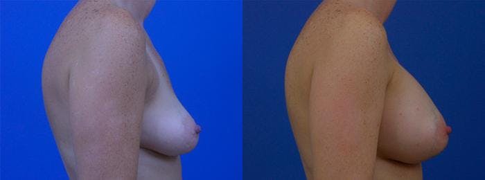Breast Augmentation Before & After Gallery - Patient 122405470 - Image 2