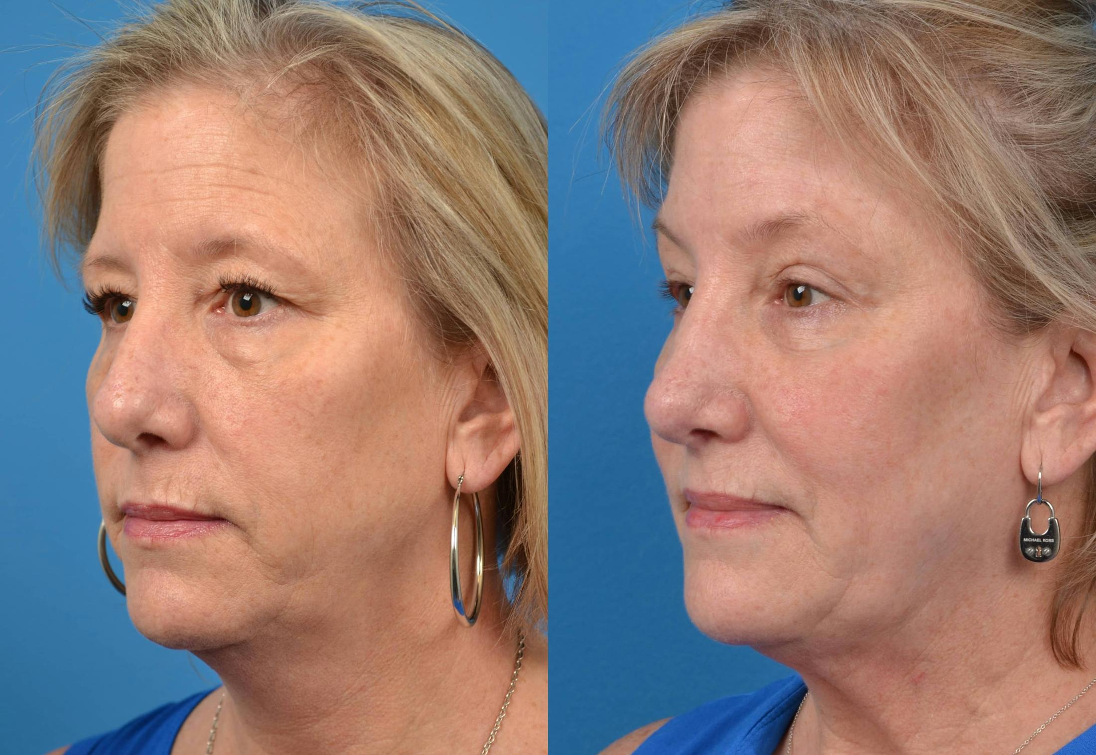 Brow Lift Before & After Gallery - Patient 122405471 - Image 2