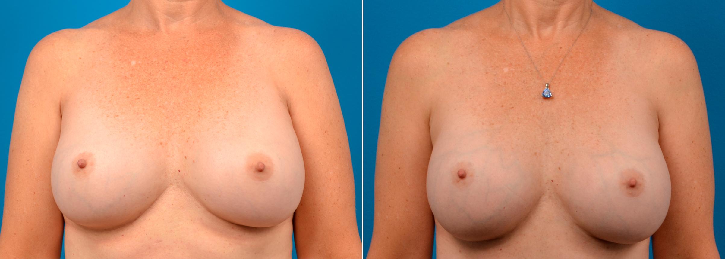 Hidden Breast Aug Before & After Gallery - Patient 948793 - Image 1