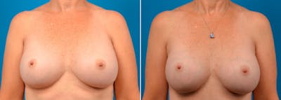Breast Augmentation Before & After Gallery - Patient 509903 - Image 1