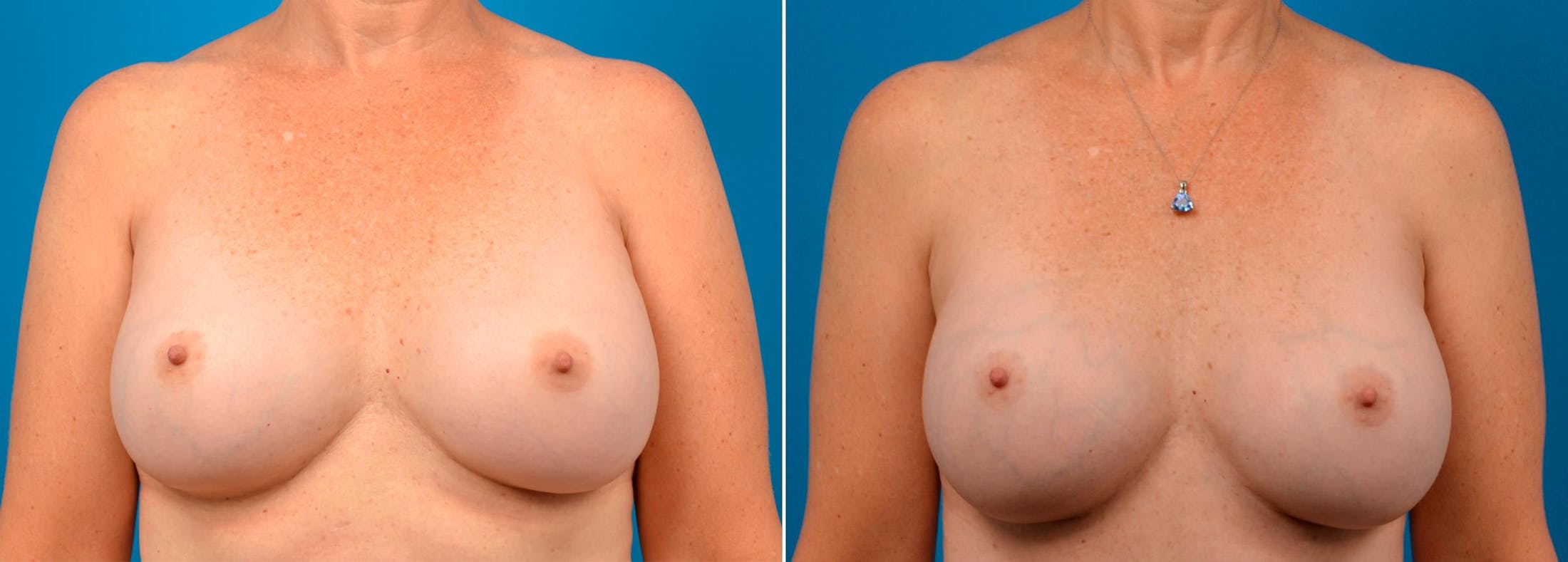 Breast Augmentation Before & After Gallery - Patient 122405472 - Image 1