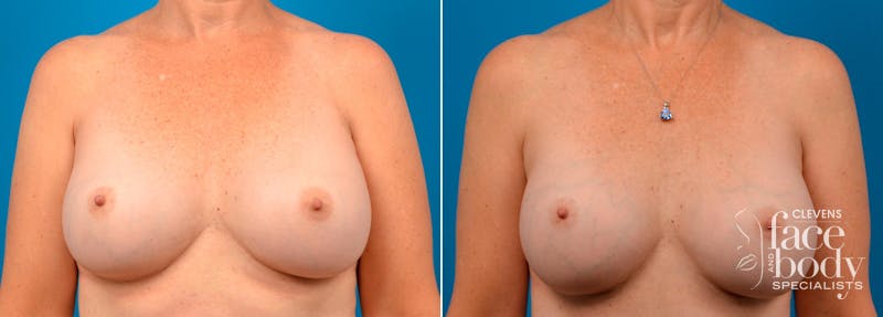 Hidden Breast Aug Before & After Gallery - Patient 234145 - Image 1