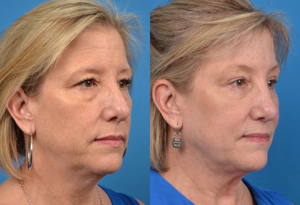 Brow Lift Before & After Gallery - Patient 122405471 - Image 3