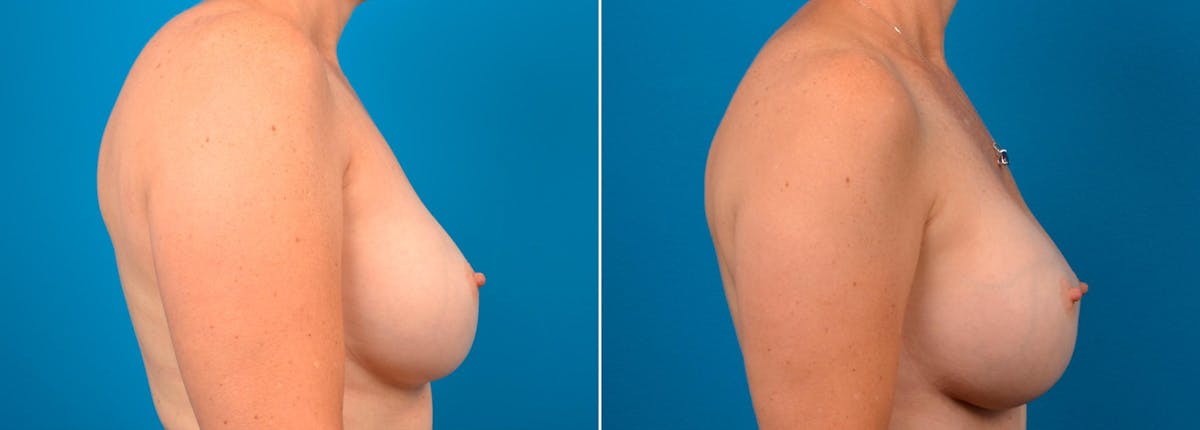 Breast Augmentation Before & After Gallery - Patient 509903 - Image 2