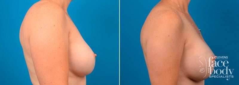 Hidden Breast Aug Before & After Gallery - Patient 234145 - Image 2
