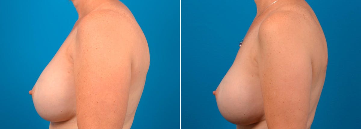 Breast Augmentation Before & After Gallery - Patient 509903 - Image 3