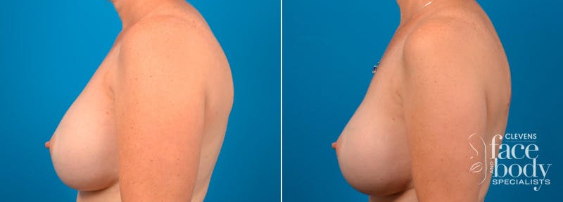 Hidden Breast Aug Before & After Gallery - Patient 234145 - Image 3