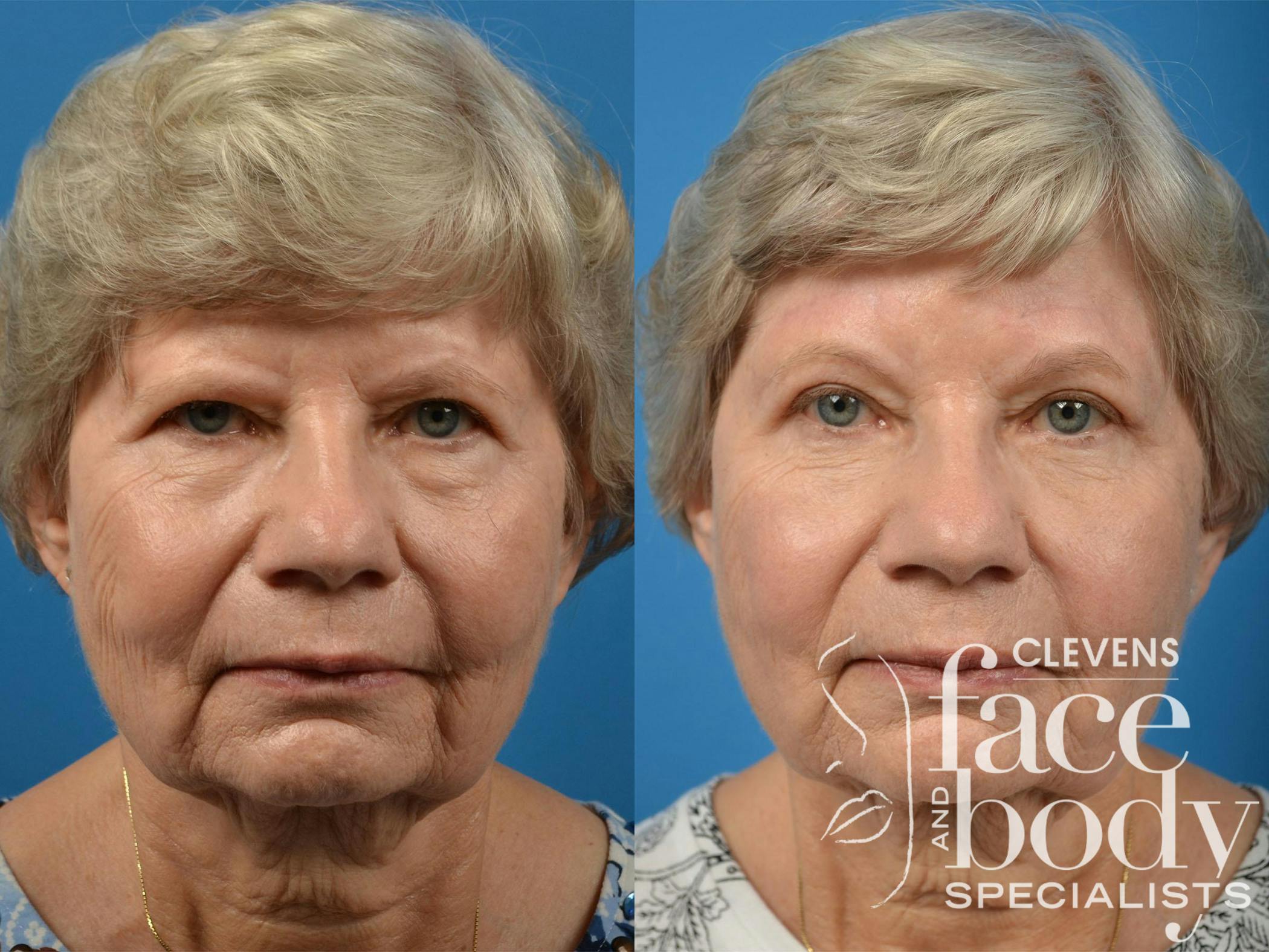 Brow Lift