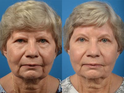 Brow Lift Before & After Gallery - Patient 122405475 - Image 1