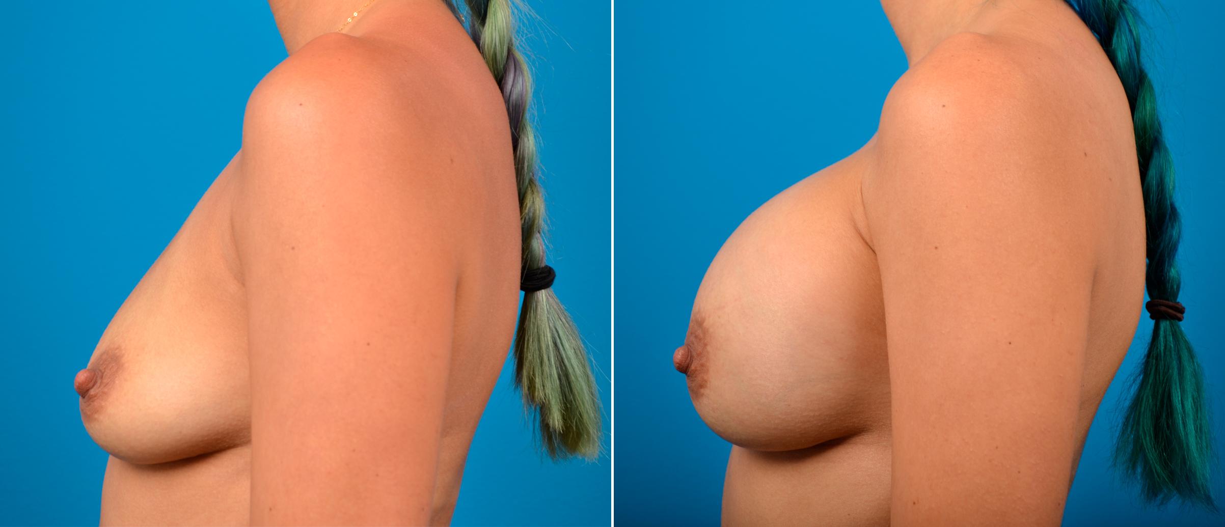 Hidden Breast Aug Before & After Gallery - Patient 143659 - Image 1