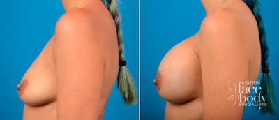 Hidden Breast Aug Before & After Gallery - Patient 143659 - Image 1