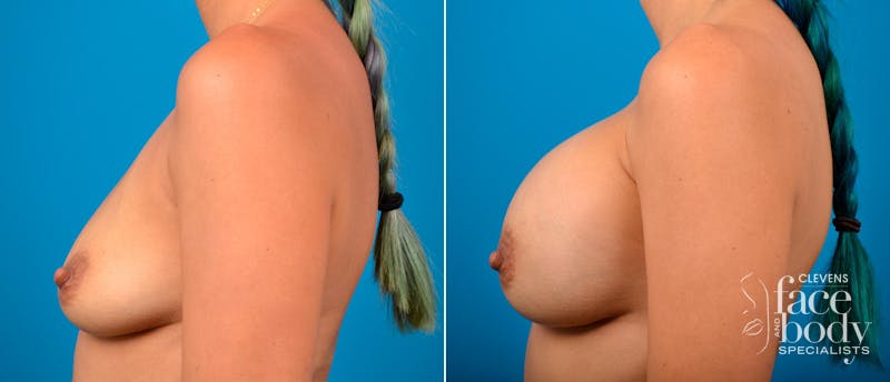 Hidden Breast Aug Before & After Gallery - Patient 179384 - Image 1
