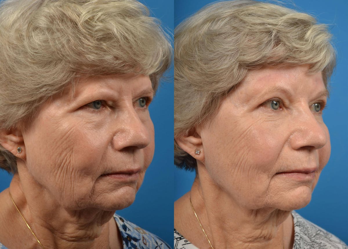 Brow Lift Before & After Gallery - Patient 122405475 - Image 2