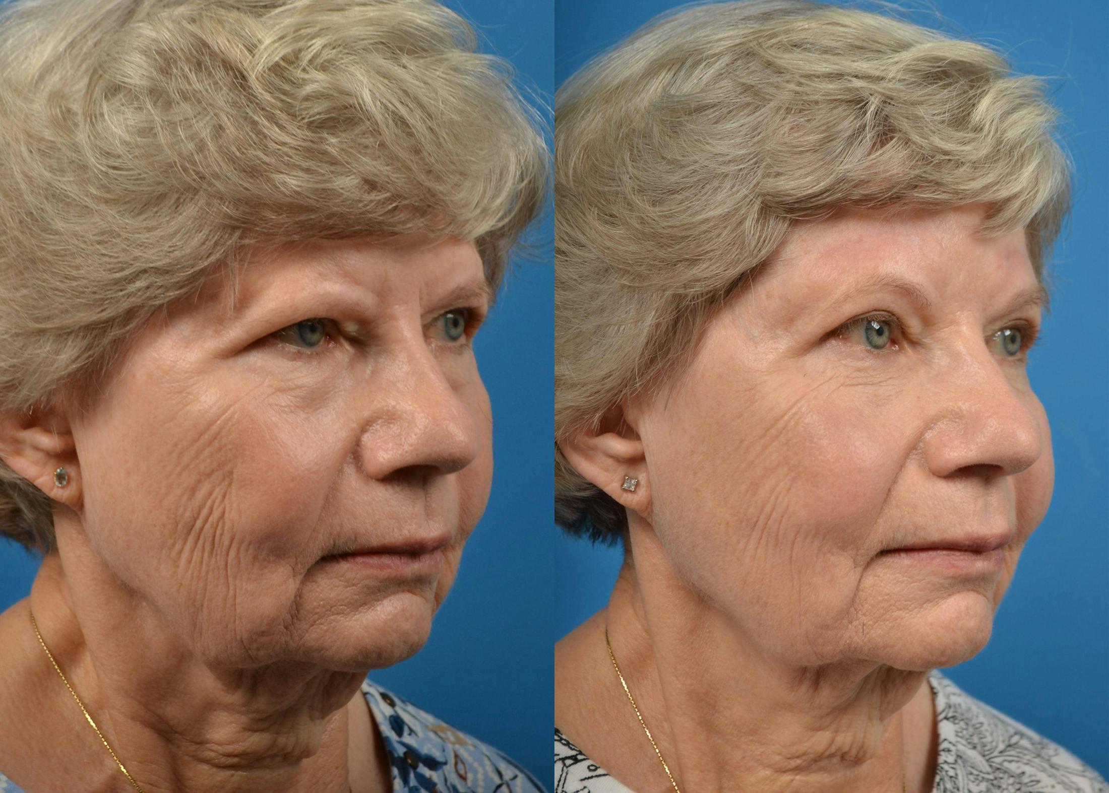 Brow Lift Before & After Gallery - Patient 122405475 - Image 2