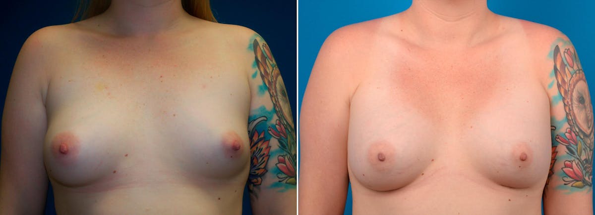Breast Augmentation Before & After Gallery - Patient 250413 - Image 1