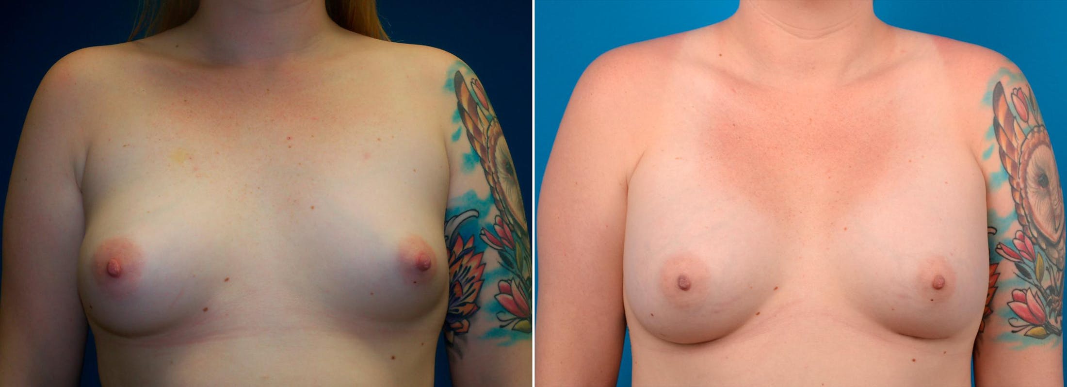 Breast Augmentation Before & After Gallery - Patient 122405474 - Image 1