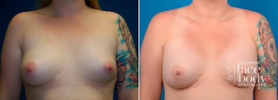 Hidden Breast Aug Before & After Gallery - Patient 952514 - Image 1
