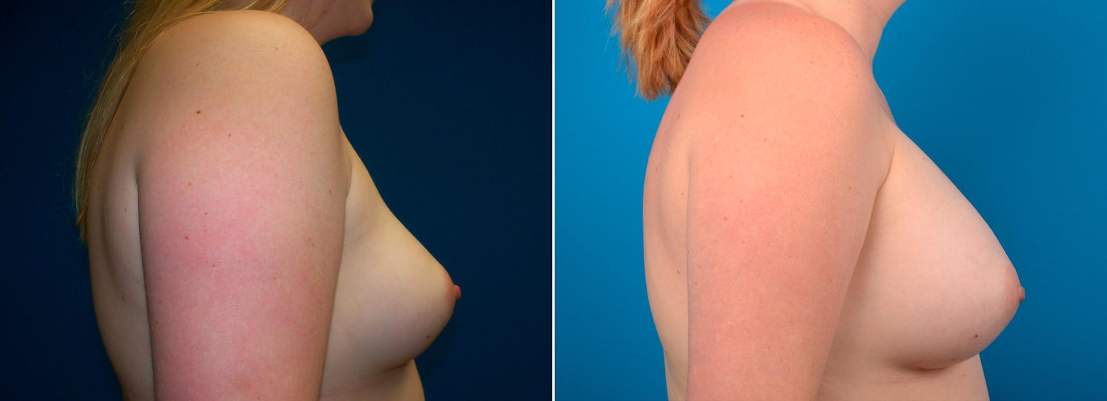 Breast Augmentation Before & After Gallery - Patient 122405474 - Image 2