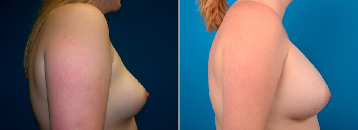 Breast Augmentation Before & After Gallery - Patient 250413 - Image 2