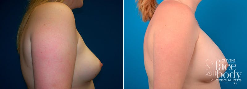Hidden Breast Aug Before & After Gallery - Patient 364552 - Image 2
